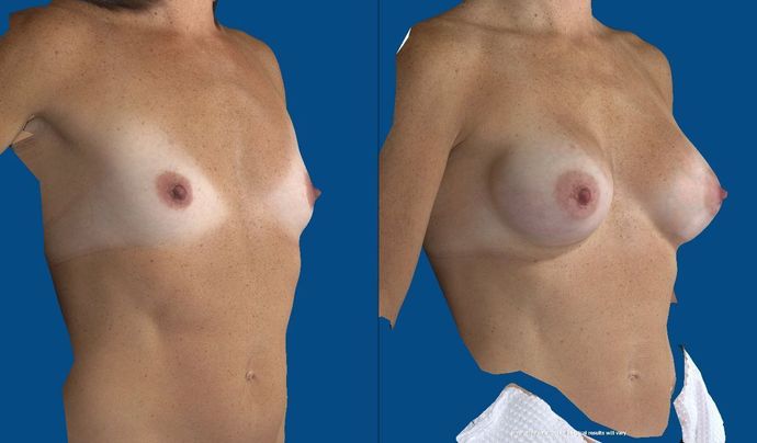 Breast Augmentation : Case 62 (21706) - Before