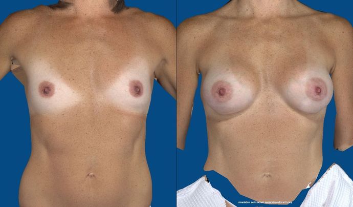 Breast Augmentation  Case 62 (21706)
