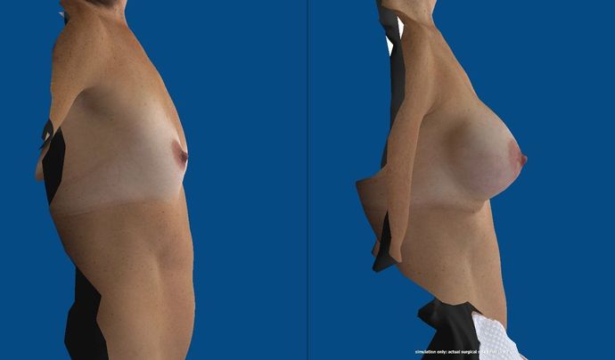 Breast Augmentation : Case 62 (21706) - Before