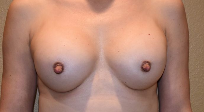 Breast Augmentation Case 532 - After