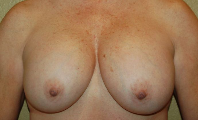 Breast Revision: Case 104 - Before
