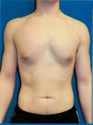 Male Breast / Gynecomastia Case 4 (18642) - Before