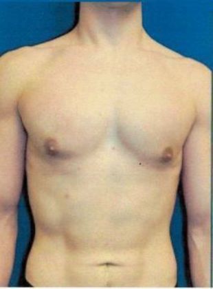 Male Breast / Gynecomastia Case 4 (18642) - After