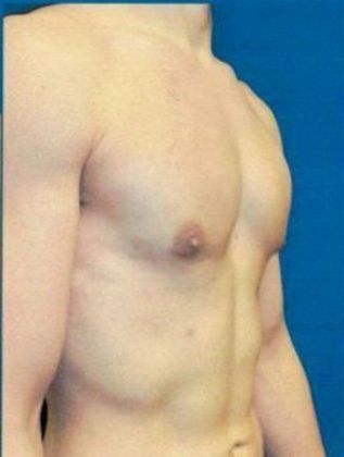 Male Breast / Gynecomastia: Case 4 (18642) - After