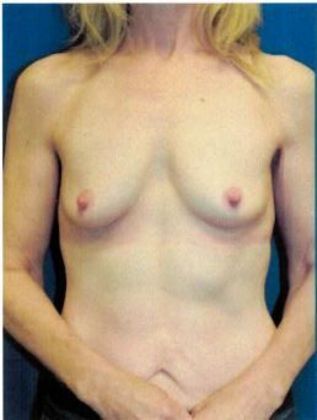 Breast Augmentation : Case 63 (21490) - Before