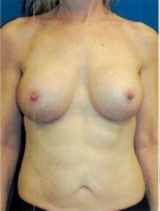 Breast Augmentation : Case 63 (21490) - Before
