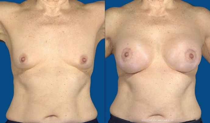 Breast Lift / Mastopexy Case 28 (20640)