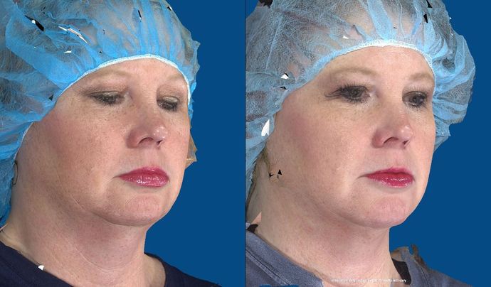 Facial Chin Implant / Augmentation: Case 1 (20741) - After