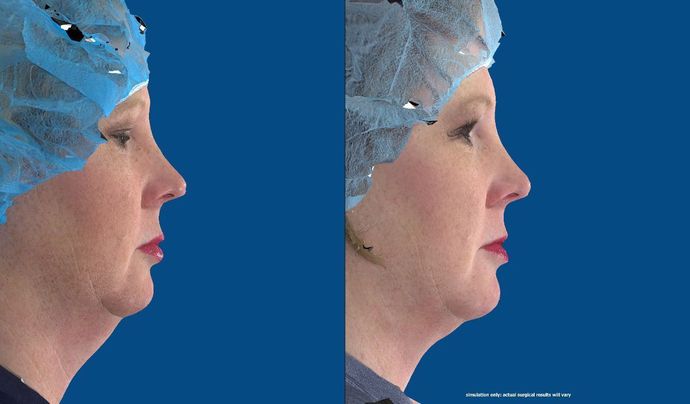 Facial Chin Implant / Augmentation Case 1 (20741)