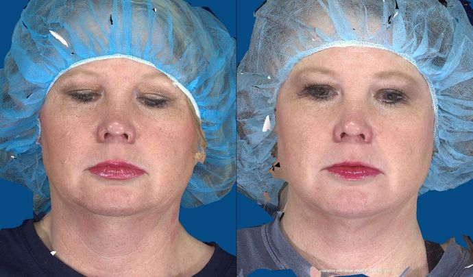 Body Liposuction: Case 7 (20741) - After