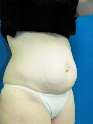 Body Tummy Tuck / Abdominoplasty: Case 16 (21104) - Before