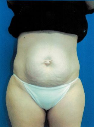 Body Tummy Tuck / Abdominoplasty Case 16 (21104) - Before