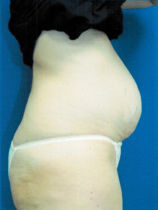 Body Tummy Tuck / Abdominoplasty: Case 16 (21104) - Before