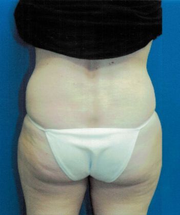 Body Tummy Tuck / Abdominoplasty: Case 16 (21104) - Before
