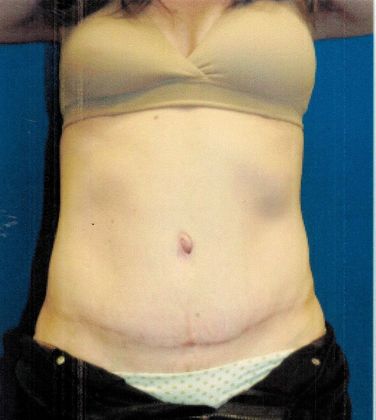 Body Tummy Tuck / Abdominoplasty Case 16 (21104) - After