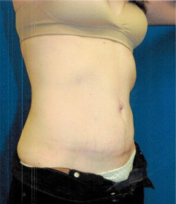 Body Tummy Tuck / Abdominoplasty: Case 16 (21104) - After