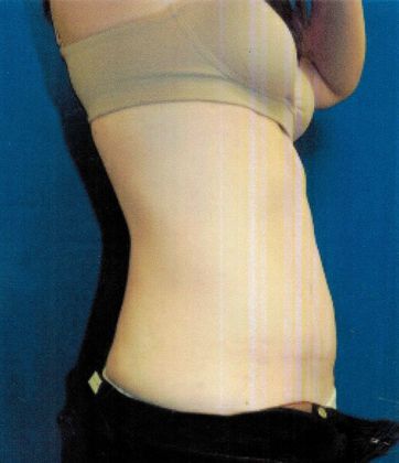 Body Tummy Tuck / Abdominoplasty: Case 16 (21104) - After