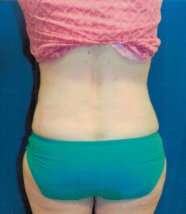Body Tummy Tuck / Abdominoplasty: Case 16 (21104) - After