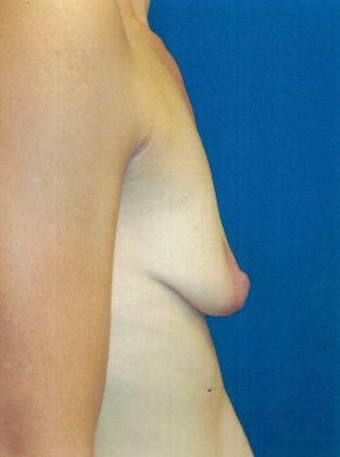 Body Mommy Make-Over: Case 3 (20816) - Before