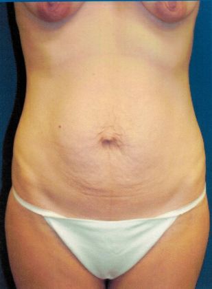 Body Mommy Make-Over Case 3 (20816) - Before