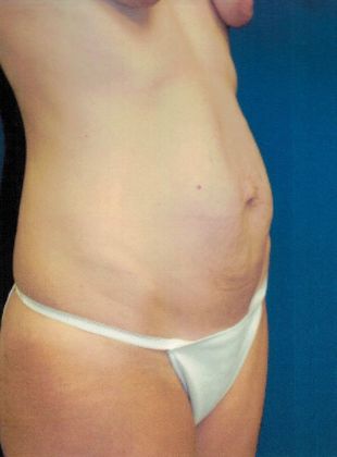 Body Mommy Make-Over: Case 3 (20816) - Before