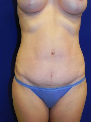 Body Mommy Make-Over Case 3 (20816) - After