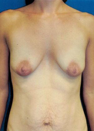 Breast Lift / Mastopexy Case 30 (20816) - Before