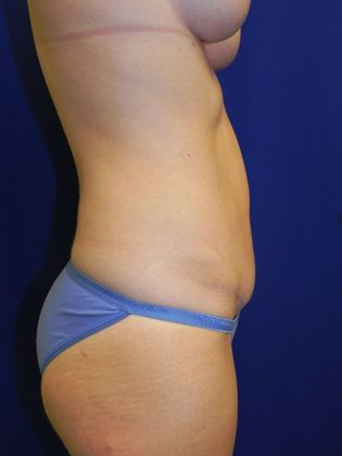 Breast Lift / Mastopexy: Case 30 (20816) - After