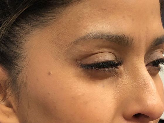 BOTOX® Cosmetic*: Case 5 - After