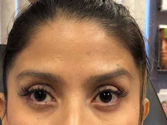 BOTOX® Cosmetic*: Case 5 - After