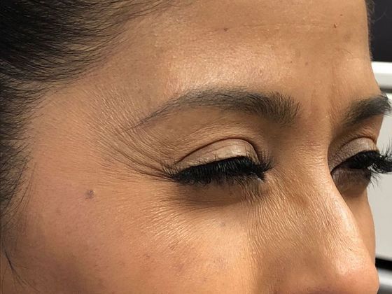 BOTOX® Cosmetic*: Case 5 - Before
