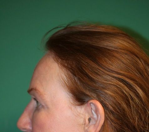 Hairline Lowering Surgery: Case 10 - Before