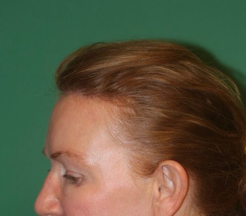 Hairline Lowering Surgery: Case 10 - After