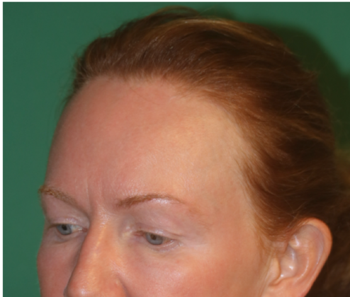 Hairline Lowering Surgery: Case 10 - Before