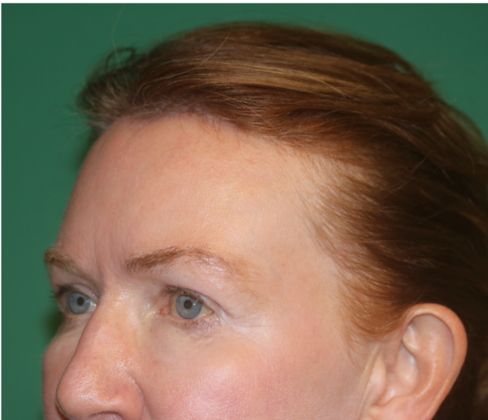 Hairline Lowering Surgery: Case 10 - After