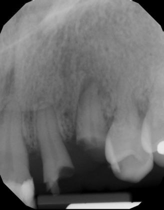 Dental Implants Case 24 - Before