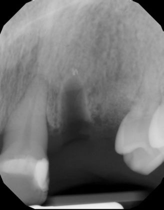 Dental Implants: Case 24 - After