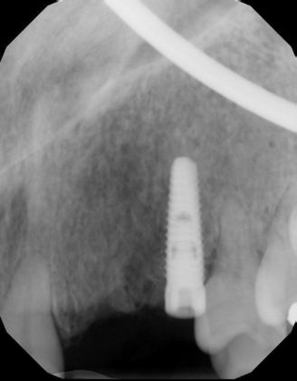 Dental Implants: Case 24 - Before