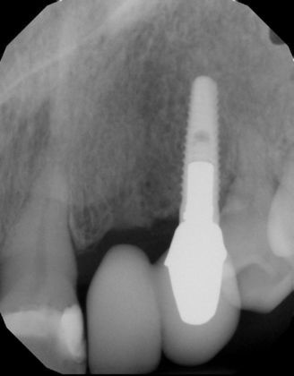 Case 24 Dental Implants Before And After Gallery   Large Image 1554230256 