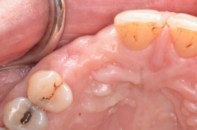 Dental Implants: Case 24 - Before