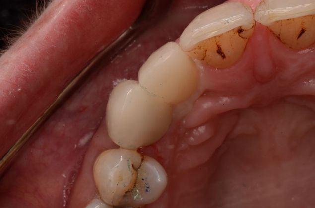 Dental Implants: Case 24 - After