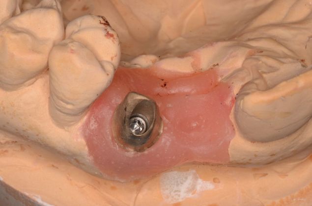 Dental Implants: Case 24 - Before