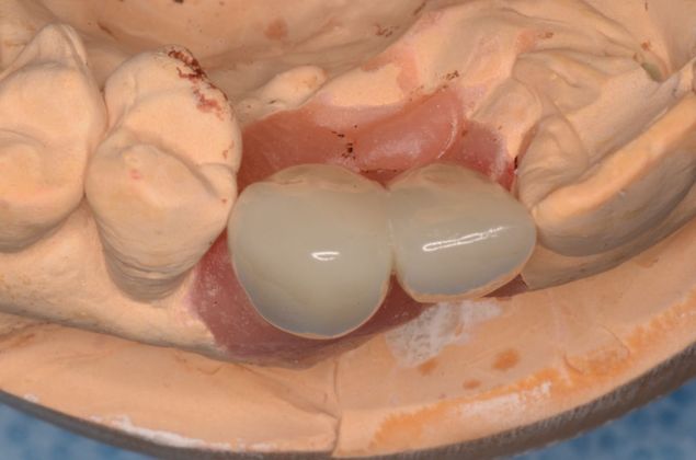 Dental Implants: Case 24 - After