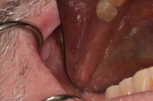 Dental Implants: Case 25 - Before