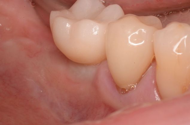 Dental Implants: Case 25 - After