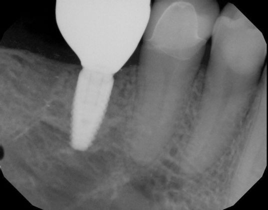 Dental Implants: Case 25 - Before