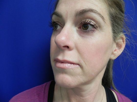 Injectables Minimally-Invasive / Fillers: Case 10 (12012) - Before