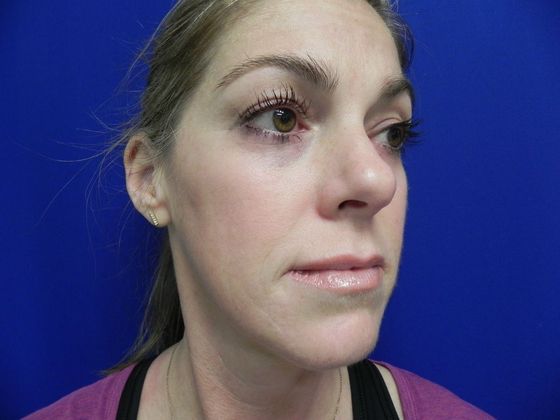 Injectables Minimally-Invasive / Fillers: Case 10 (12012) - Before