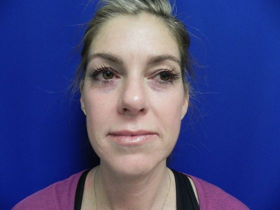 Injectables Minimally-Invasive / Fillers: Case 10 (12012) - Before