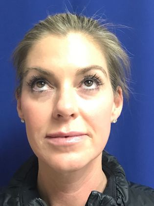 Injectables Minimally-Invasive / Fillers: Case 10 (12012) - After - cheekbones enhanced